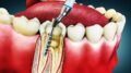 Root Canal