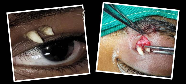 Ectopic Tooth কী? পুরো বিশ্বকে চমকে দিয়েছে ভারতের এই ঘটনা